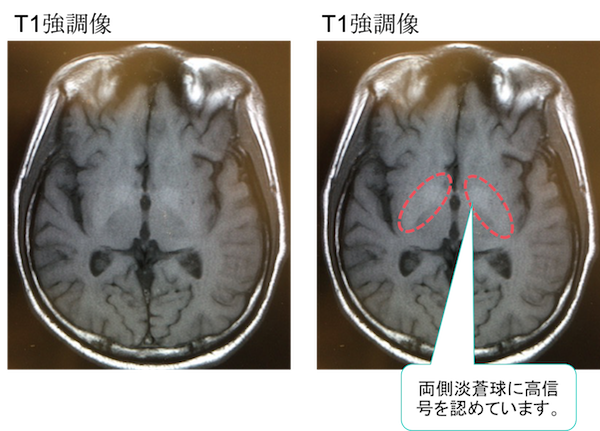 hepatic encephalopathy MRI findings3