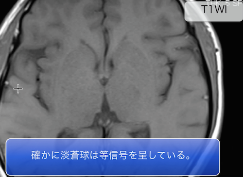 hepatic encephalopathy1