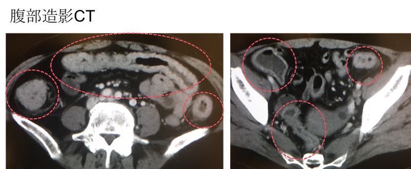 ulcerative colitis CT findings