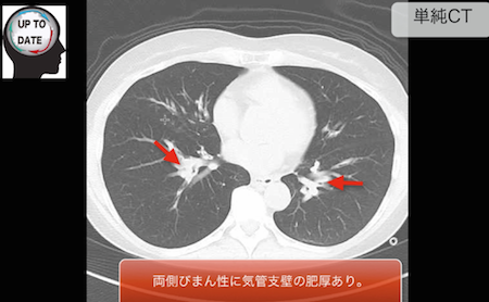 bronchial asthma1