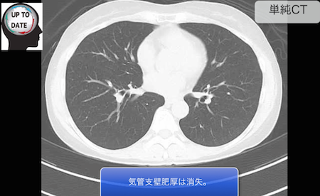bronchial asthma2