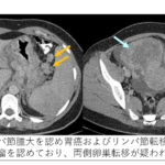 卵巣腫瘍 オファー ステントグラス