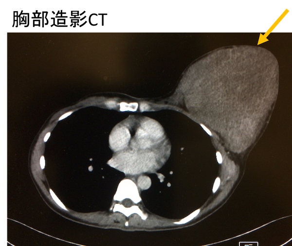 Phyllodes tumor CT findings1