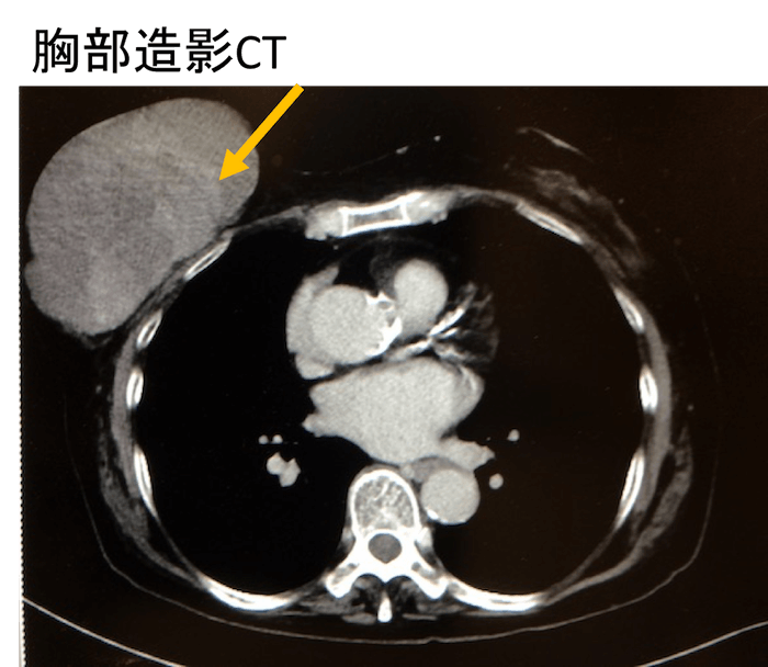 葉状腫瘍のCT画像