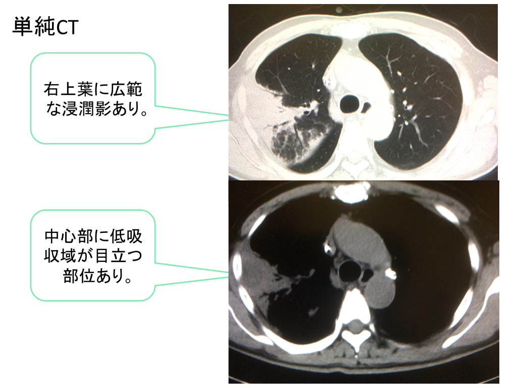 lung-abscess-ct-findings-001