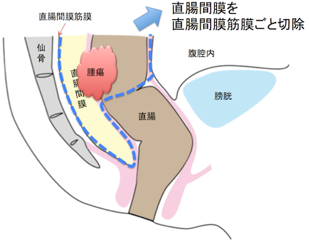 mesorectum&mesorectal fascia1
