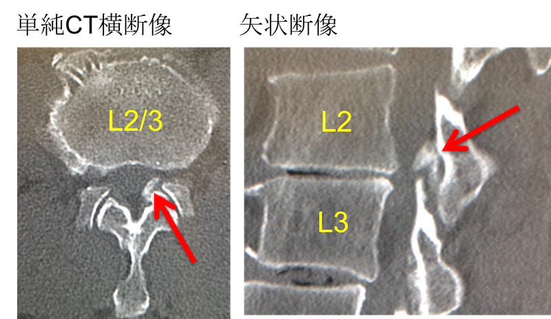 ossification-of-yellow-ligament