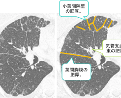 癌性リンパ管症の CT 画像