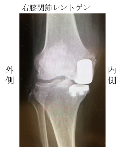 UKA（Unicompartmental Knee Arthroplasty）