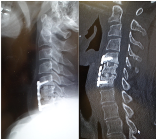 ASF:ACSF(anterior cervical spine fixation)