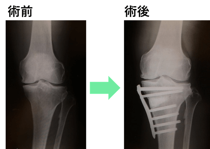 高位脛骨骨切り術（High Tibial Osteotomy : HTO）のレントゲン画像