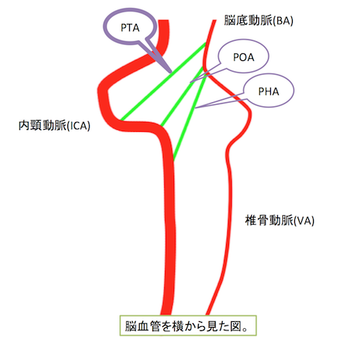 persistent trigeminal artery
