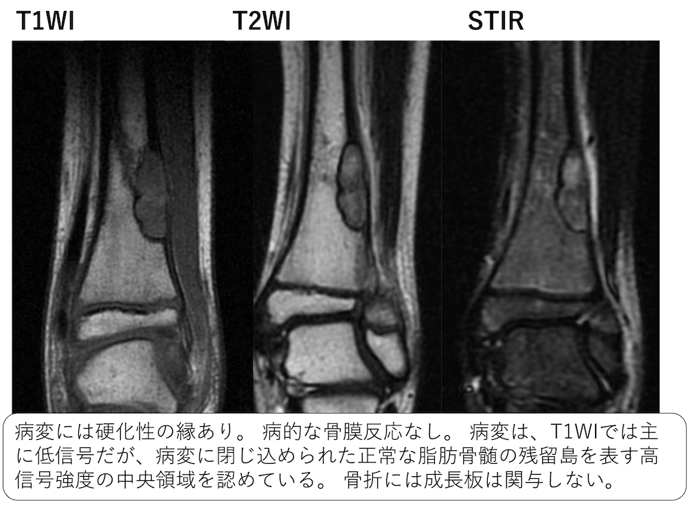 Non-ossifying fibroma