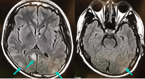 結節性硬化症における皮質結節のMRI画像
