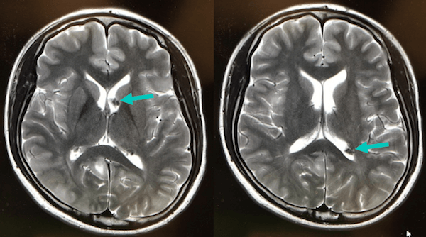 結節性硬化症における上衣下結節のMRI画像