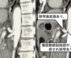正中弓状靱帯症候群のCT画像