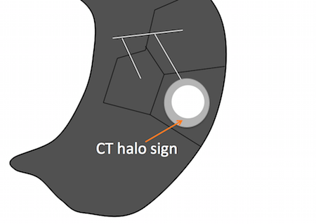 CT halo sign