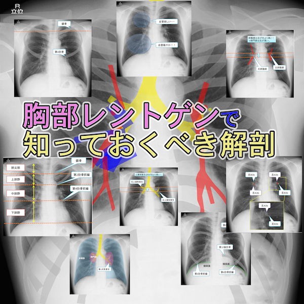 normal-anatomy-of-chest-Xray-examin