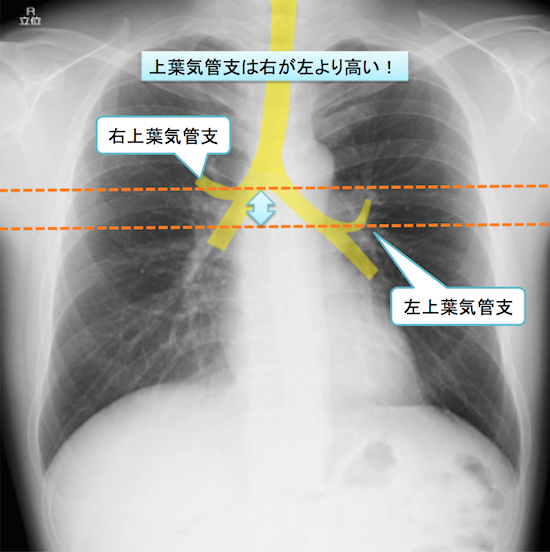 normal anatomy of chest Xray11