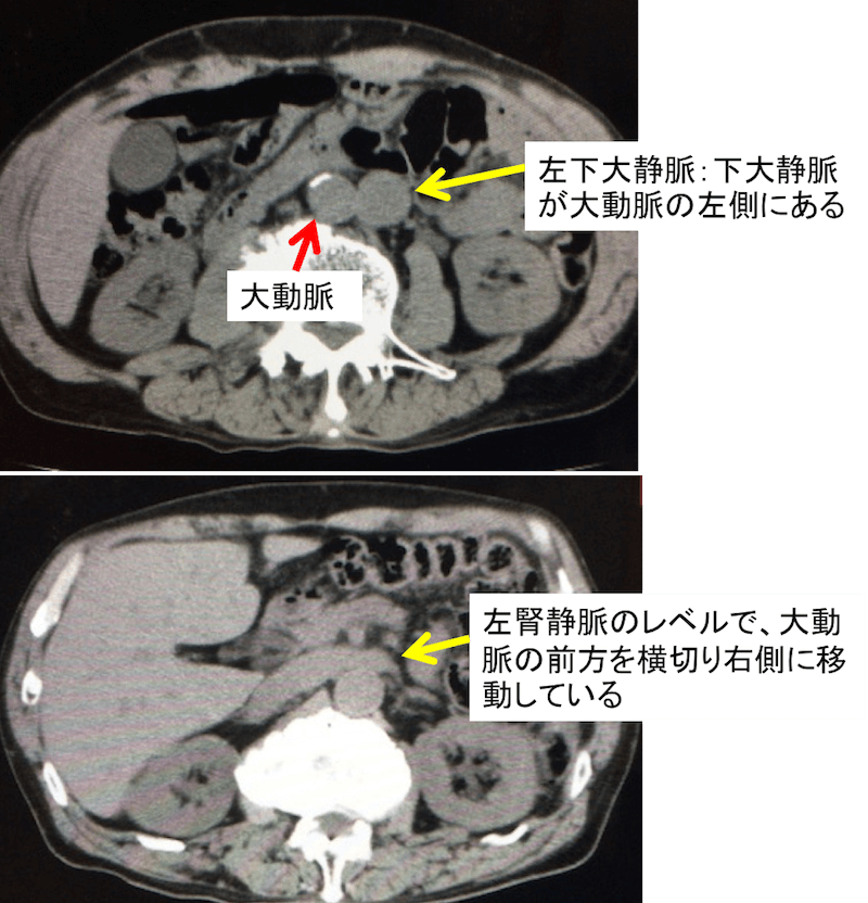 左下大静脈のCT画像