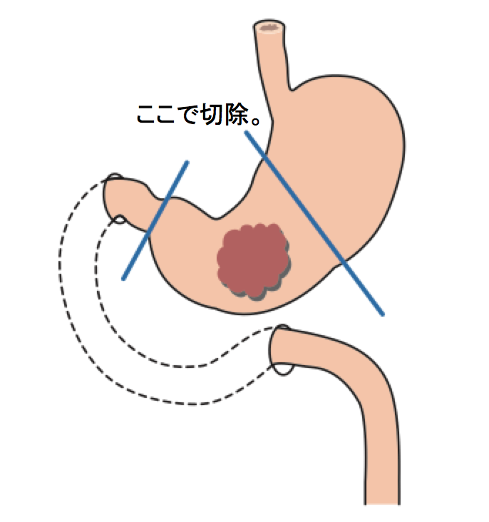 Distal gastrectomy