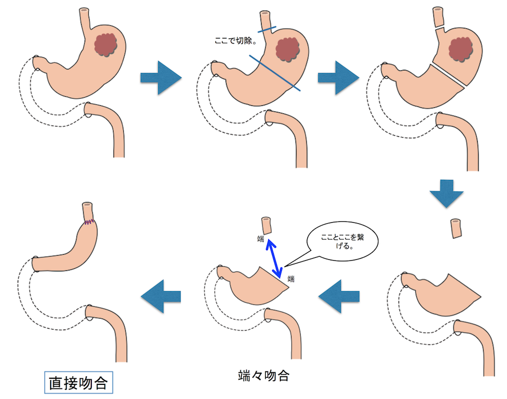 fundusectomy1