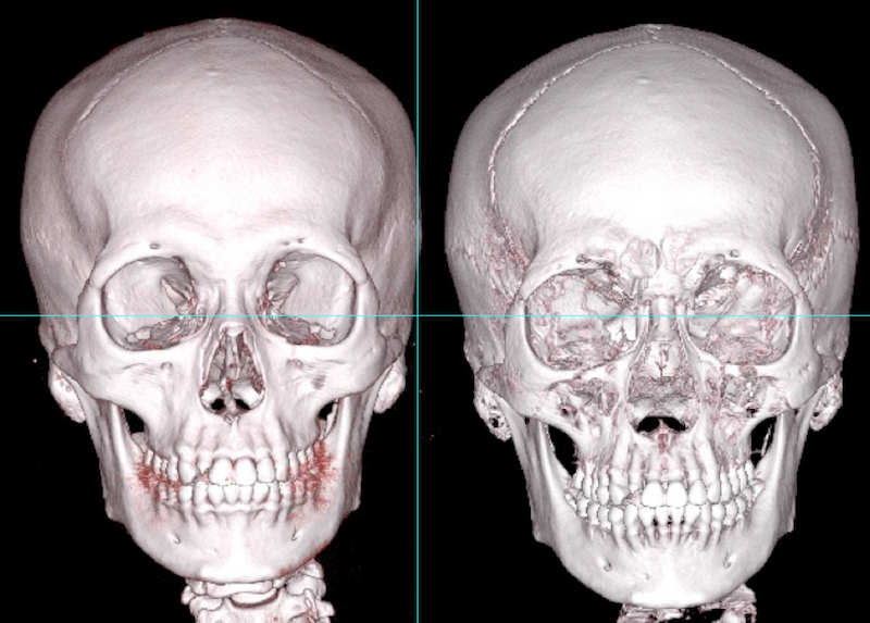 facial bone anatomy