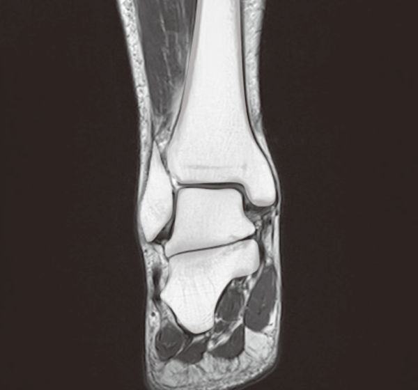 ankle mri3