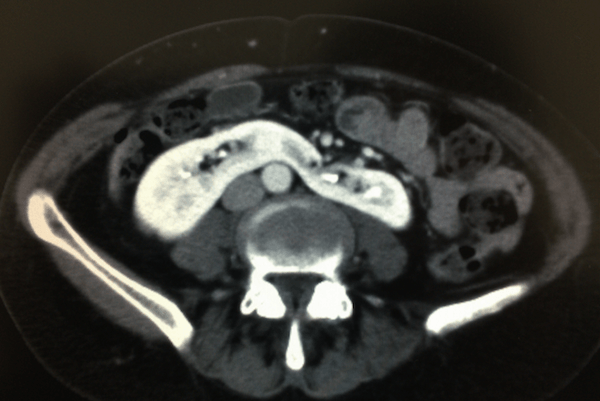 馬蹄腎のCT画像
