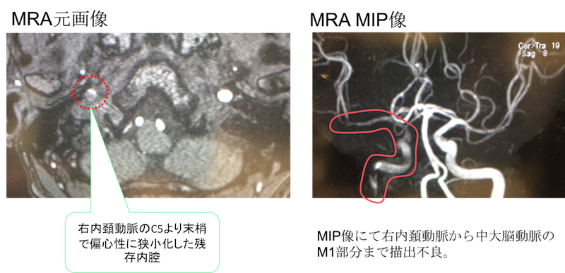 internal carotid artery dissection MRI findings2