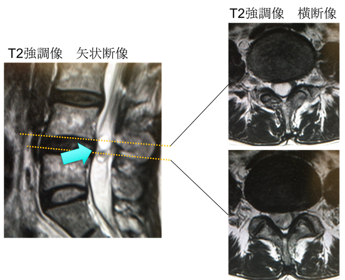 schwannoma mri findigs2