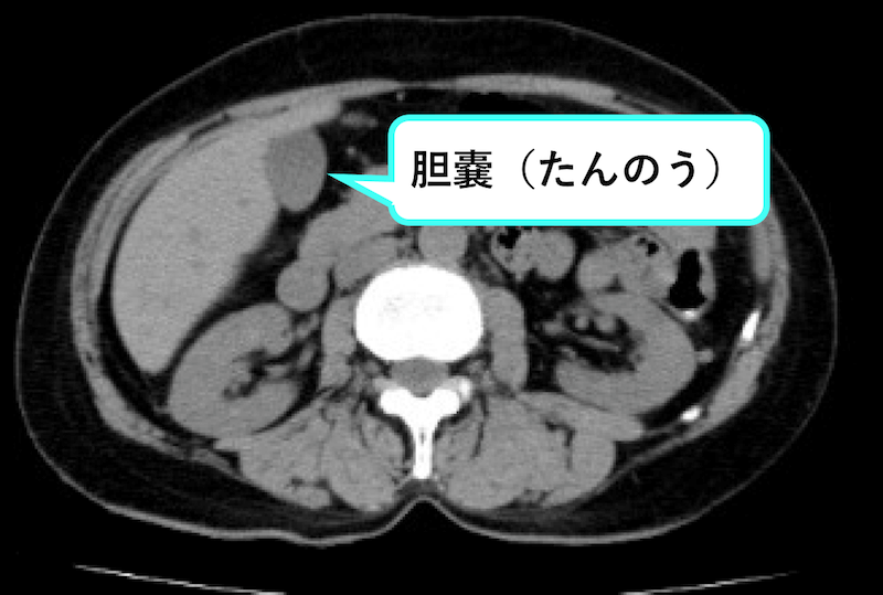 腹部のCT - その他