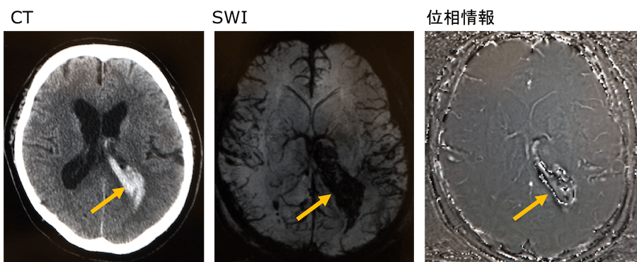 MRIのSWIで出血を示唆する画像