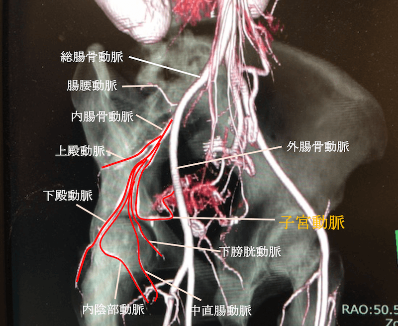 内腸骨動脈の分枝・子宮動脈の解剖のCTAの画像