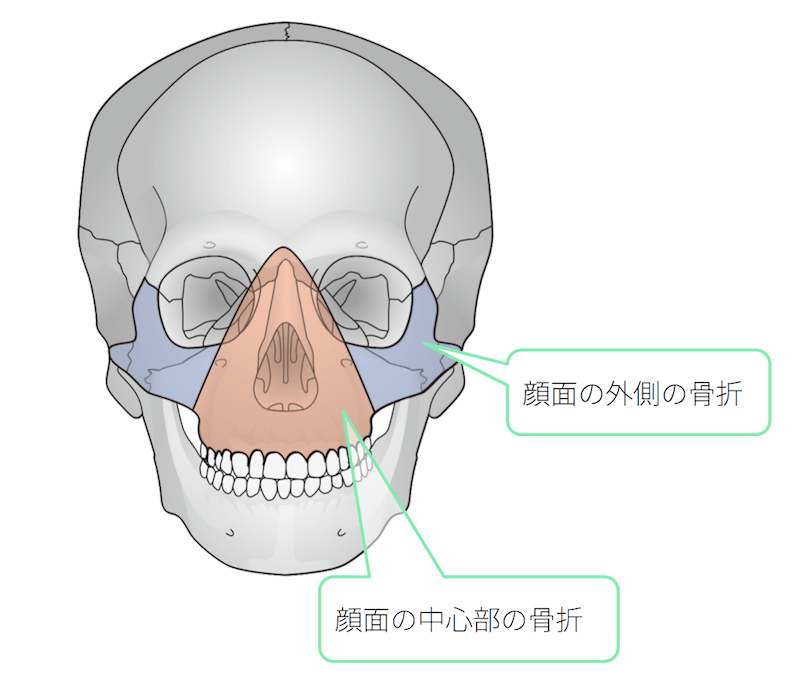 保存版】顔面骨折とは？症状やCT画像診断、治療法を徹底まとめ！