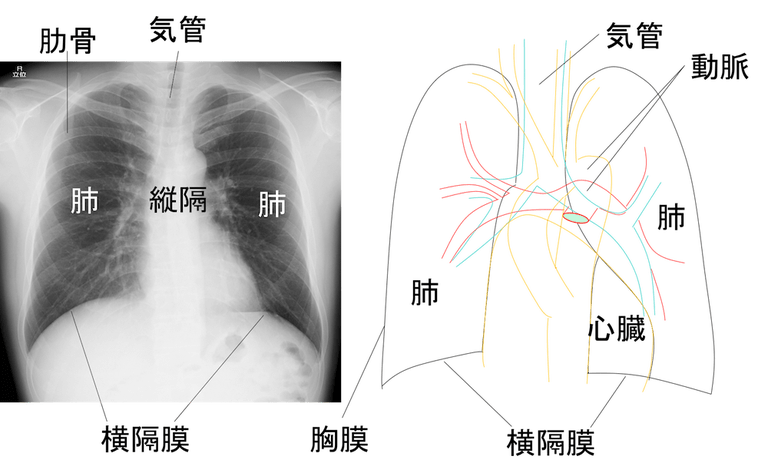 画像あり】胸部レントゲンの所見で異常所見あり！？どんな病気が考え