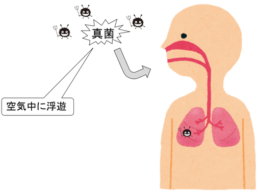 肺アスペルギルス症
