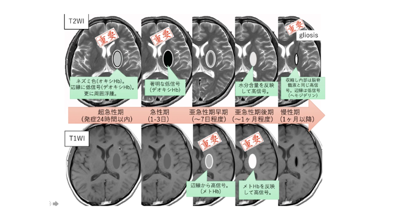 T1WI　T2WI　脳出血　継時的変化　