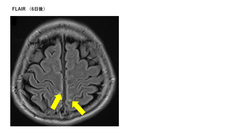40歳代男性　FLAIR（6日後）