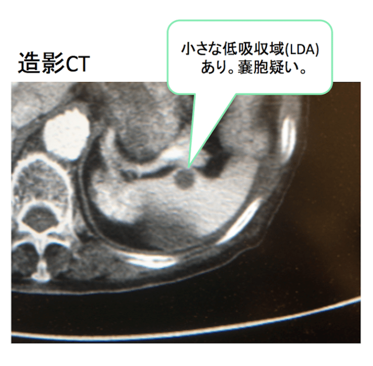 エコーやCTで脾臓の腫瘍を指摘された！鑑別は？症状は？