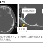 occopitomastoid-suture1-1-