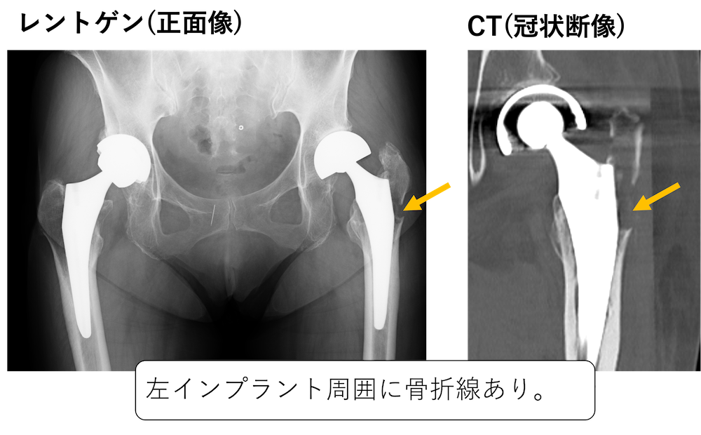 インプラント周囲骨折を極める - 本