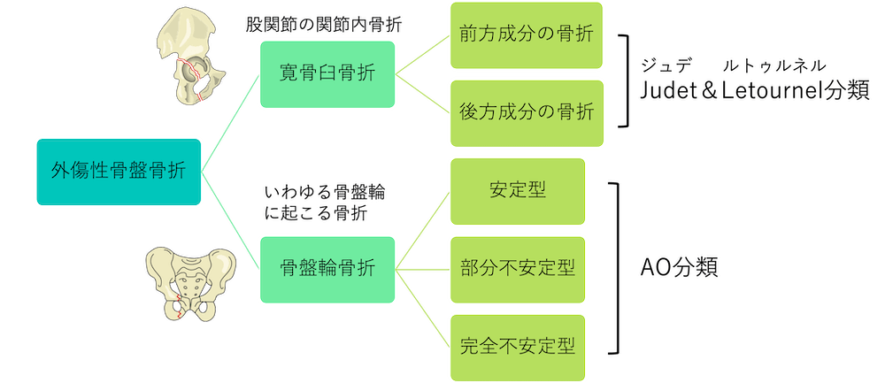 外傷性骨盤骨折の分類(骨盤輪骨折、寛骨臼骨折)とCT画像診断のポイント！