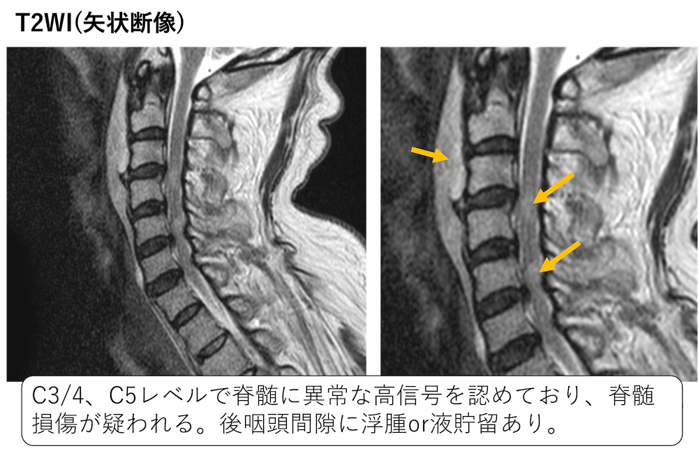 脊髄損傷のCT,MRI画像診断のポイント