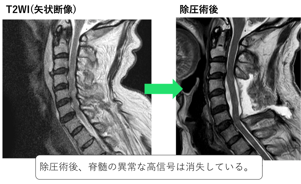 新品即決 第3版 美品 エキスパートのための脊椎脊髄疾患のMRI 第３版の 