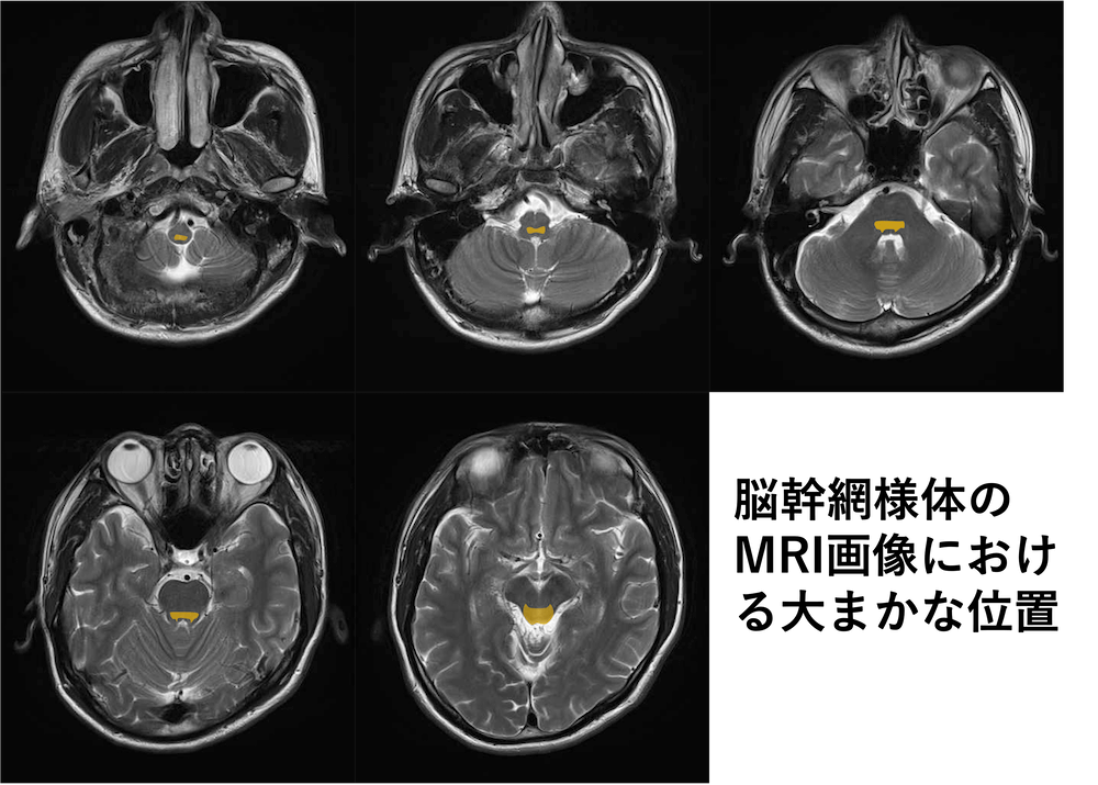 脳幹網様体のMRI画像における大まかな位置、場所