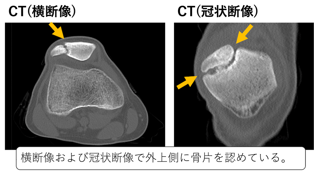 二分膝蓋骨(bipartite type)のCT画像