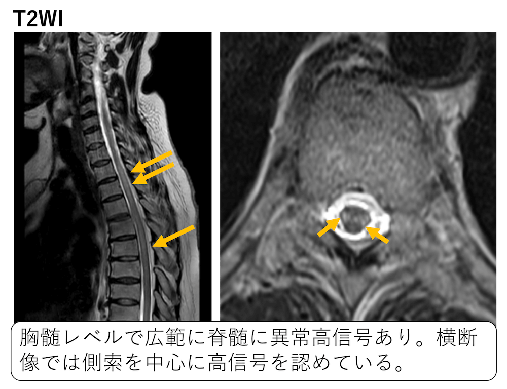 脊髄側索を侵す疾患の鑑別診断