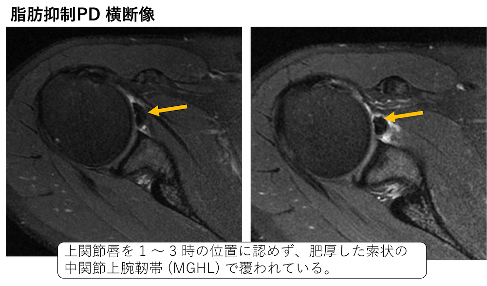 肩関節のMRI−読影ポイントのすべて :20230413105348-00168us:RAVI 