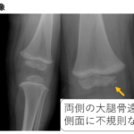 epiphyseal-cortical-